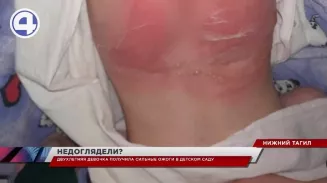 Двухлетняя девочка получила ожоги второй и третьей степени в детском саду Двухлетняя девочка получила ожоги второй и третьей степени в детском саду