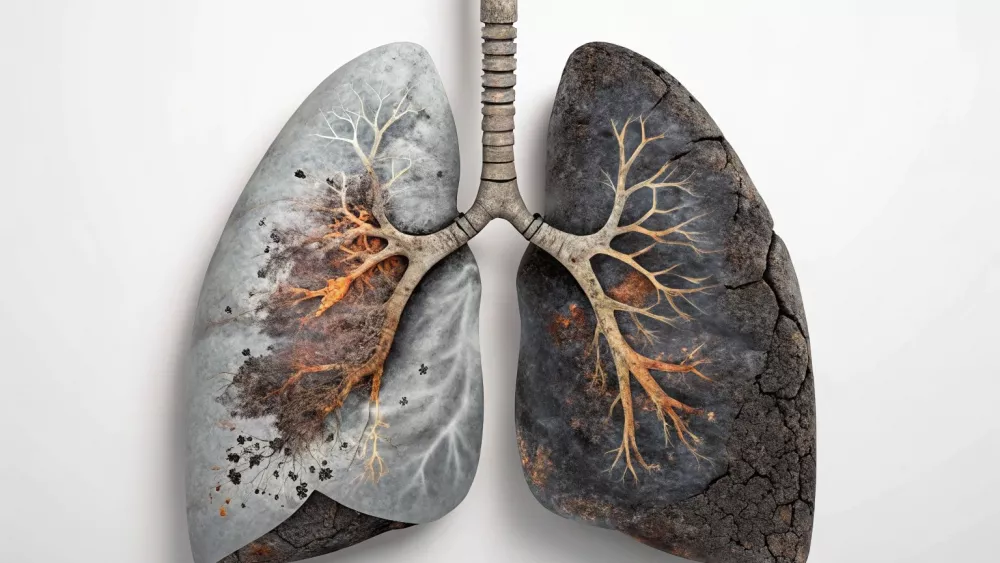 Каждый четвёртый больной раком лёгкого — некурящий
