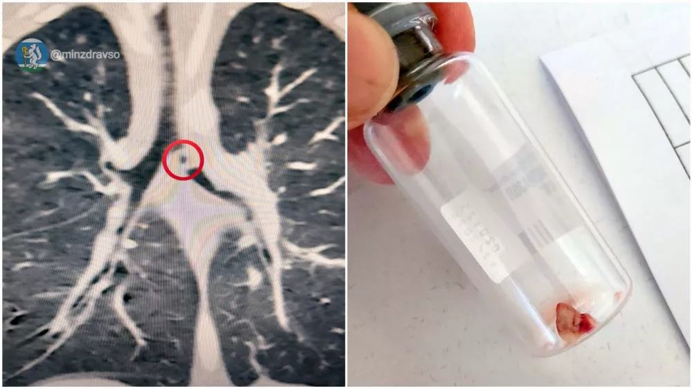 Малыша с кусочком печки в бронхе спасли свердловские медики