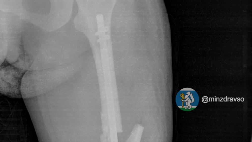 Сломала ногу, выпав из окна: врачи восстановили перелом беременной екатеринбурженки