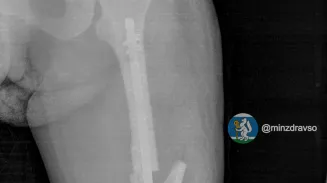 Сломала ногу, выпав из окна: врачи восстановили перелом беременной екатеринбурженки