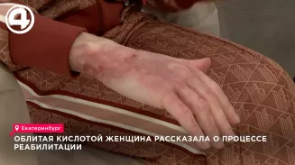 Облитая кислотой женщина рассказала о процессе реабилитации