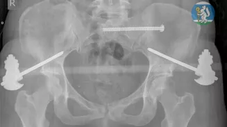 Уральские врачи спасли женщину, упавшую с седьмого этажа во время мытья окон Уральские врачи спасли женщину, упавшую с седьмого этажа во время мытья окон