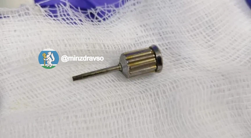 Стоматологическую отвертку достали из кишечника пациентки в Екатеринбурге