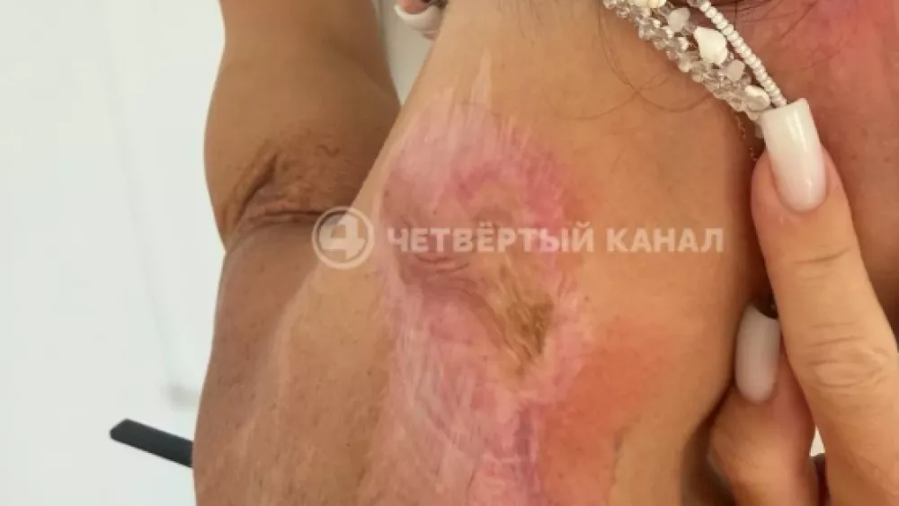 «Шея не поворачивается, кисти не сгибаются»: девушка, облитая «кислотой», рассказала, как живет
